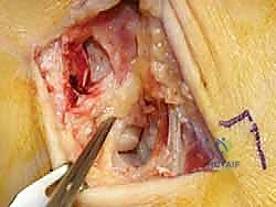 صورة طبية: إعادة بناء أربطة الكاحل الإنسية ورباط الدالية: استعادة الاستقرار والحركة في صنعاء مع الأستاذ الدكتور محمد هطيف