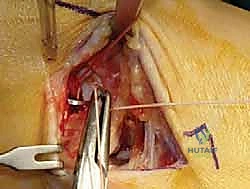 صورة طبية: إعادة بناء أربطة الكاحل الإنسية ورباط الدالية: استعادة الاستقرار والحركة في صنعاء مع الأستاذ الدكتور محمد هطيف