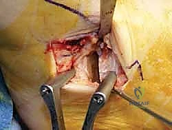 صورة توضيحية لـ إعادة بناء أربطة الكاحل الإنسية ورباط الدالية: استعادة الاستقرار والحركة في صنعاء مع الأستاذ الدكتور محمد هطيف