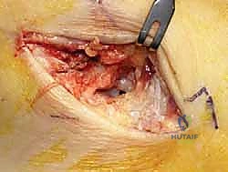 صورة طبية: إعادة بناء أربطة الكاحل الإنسية ورباط الدالية: استعادة الاستقرار والحركة في صنعاء مع الأستاذ الدكتور محمد هطيف