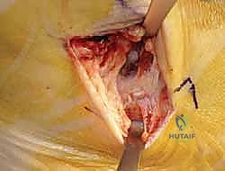 صورة توضيحية لـ إعادة بناء أربطة الكاحل الإنسية ورباط الدالية: استعادة الاستقرار والحركة في صنعاء مع الأستاذ الدكتور محمد هطيف