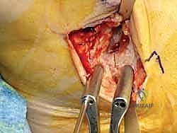 صورة طبية: إعادة بناء أربطة الكاحل الإنسية ورباط الدالية: استعادة الاستقرار والحركة في صنعاء مع الأستاذ الدكتور محمد هطيف