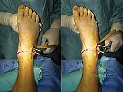 صورة طبية: إعادة بناء أربطة الكاحل الإنسية ورباط الدالية: استعادة الاستقرار والحركة في صنعاء مع الأستاذ الدكتور محمد هطيف