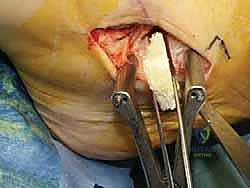 صورة طبية: إعادة بناء أربطة الكاحل الإنسية ورباط الدالية: استعادة الاستقرار والحركة في صنعاء مع الأستاذ الدكتور محمد هطيف