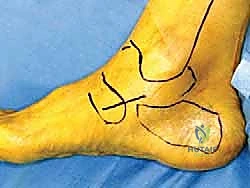 صورة طبية: إعادة بناء أربطة الكاحل الإنسية ورباط الدالية: استعادة الاستقرار والحركة في صنعاء مع الأستاذ الدكتور محمد هطيف