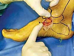 صورة توضيحية لـ إعادة بناء أربطة الكاحل الإنسية ورباط الدالية: استعادة الاستقرار والحركة في صنعاء مع الأستاذ الدكتور محمد هطيف