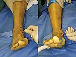 صورة طبية: إعادة بناء أربطة الكاحل الإنسية ورباط الدالية: استعادة الاستقرار والحركة في صنعاء مع الأستاذ الدكتور محمد هطيف