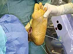 صورة طبية: إعادة بناء أربطة الكاحل الإنسية ورباط الدالية: استعادة الاستقرار والحركة في صنعاء مع الأستاذ الدكتور محمد هطيف