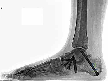 صورة طبية: إعادة بناء أربطة الكاحل الإنسية ورباط الدالية: استعادة الاستقرار والحركة في صنعاء مع الأستاذ الدكتور محمد هطيف
