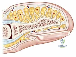 Illustration of vy advancement flaps - Dr. Mohammed Hutaif