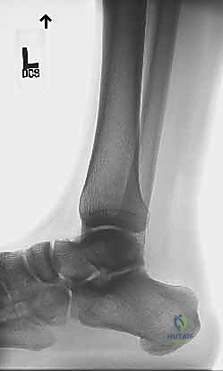 صورة توضيحية: إجراء اختبار طومسون لتأكيد تمزق وتر أخيل المفتوح
