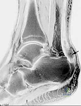 صورة توضيحية لـ إصلاح وتر أخيل المفتوح بتقنية "صندوق الهدايا": دليل شامل من الأستاذ الدكتور محمد هطيف