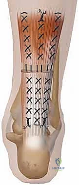 صورة توضيحية لـ إصلاح وتر أخيل المفتوح بتقنية "صندوق الهدايا": دليل شامل من الأستاذ الدكتور محمد هطيف
