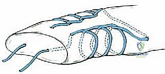 صورة طبية: إصلاح وتر أخيل المفتوح بتقنية "صندوق الهدايا": دليل شامل من الأستاذ الدكتور محمد هطيف