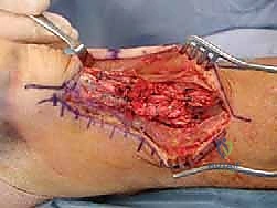 صورة طبية: إصلاح وتر أخيل المفتوح بتقنية "صندوق الهدايا": دليل شامل من الأستاذ الدكتور محمد هطيف