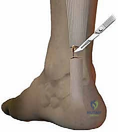 أسباب وعوامل خطر تمزق وتر أخيل