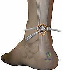 عمل الشق الجراحي الصغير فوق منطقة التمزق