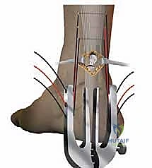 صورة توضيحية لـ إصلاح تمزق وتر أخيل المحدود بالمنظار: دليل شامل من الأستاذ الدكتور محمد هطيف في صنعاء