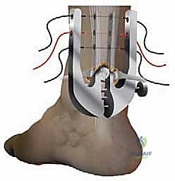 صورة توضيحية لـ إصلاح تمزق وتر أخيل المحدود بالمنظار: دليل شامل من الأستاذ الدكتور محمد هطيف في صنعاء