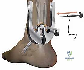 صورة توضيحية لـ إصلاح تمزق وتر أخيل المحدود بالمنظار: دليل شامل من الأستاذ الدكتور محمد هطيف في صنعاء