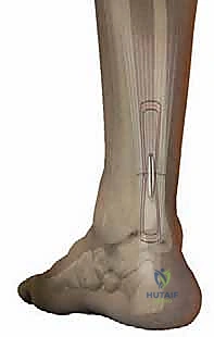 صورة طبية: إصلاح تمزق وتر أخيل المحدود بالمنظار: دليل شامل من الأستاذ الدكتور محمد هطيف في صنعاء