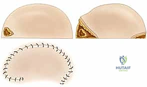 انكشاف الأنسجة العميقة بعد الإصابة