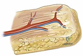 إصابة بالغة تتطلب تدخلاً ترميمياً