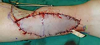 تحضير الأوعية الدموية المستقبلة