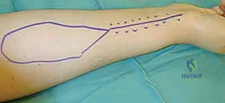 دقة الجراحة المجهرية في اليمن