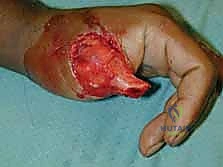 استخدام الميكروسكوب في الجراحة المجهرية