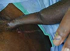 صورة توضيحية لـ ترميم الأطراف العلوية المتقدم: تقنيات السدائل الجراحية لإعادة الوظيفة والجمال مع الأستاذ الدكتور محمد هطيف