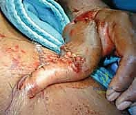 المفاغرة المجهرية الدقيقة