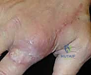 خطوات السديلة الموضعية