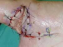 صورة توضيحية لـ ترميم الأطراف العلوية المتقدم: تقنيات السدائل الجراحية لإعادة الوظيفة والجمال مع الأستاذ الدكتور محمد هطيف