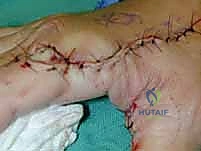 حصد السديلة مع الحفاظ على عنقها الدموي