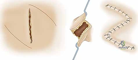 تنظيف الجرح وإزالة الأنسجة التالفة