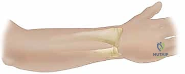 عزل الشريان والوريد المغذي