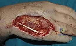 استخراج سديلة إقليمية من الساعد