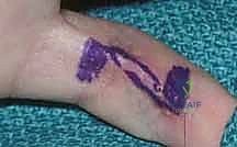 صورة توضيحية لـ ترميم الأطراف العلوية المتقدم: تقنيات السدائل الجراحية لإعادة الوظيفة والجمال مع الأستاذ الدكتور محمد هطيف