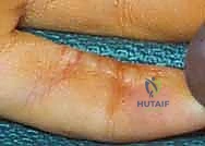 صورة توضيحية لـ ترميم الأطراف العلوية المتقدم: تقنيات السدائل الجراحية لإعادة الوظيفة والجمال مع الأستاذ الدكتور محمد هطيف