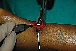 صورة توضيحية لـ إصلاح وتر أخيل بالحد الأدنى للتدخل الجراحي: دليل شامل للمرضى