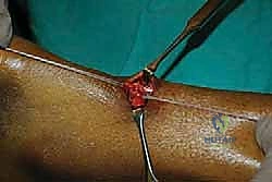 صورة طبية: إصلاح وتر أخيل بالحد الأدنى للتدخل الجراحي: دليل شامل للمرضى