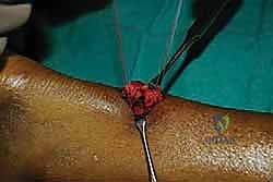 صورة توضيحية لـ إصلاح وتر أخيل بالحد الأدنى للتدخل الجراحي: دليل شامل للمرضى