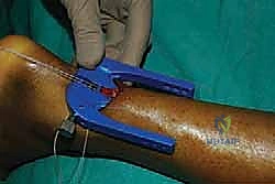 إصلاح وتر أخيل بالحد الأدنى للتدخل الجراحي: دليل شامل للمرضى