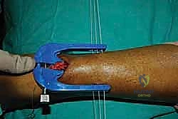 الأعراض السريرية لتمزق وتر أخيل