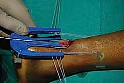 مقارنة بين الجراحة التقليدية والحد الأدنى