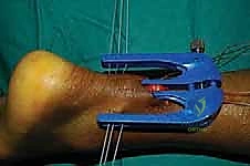 تمرير الخيوط عبر الوتر القريب