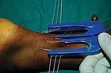 سحب الخيوط من الشق الأوسط