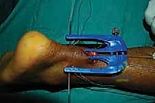 تنظيف نهايات الوتر