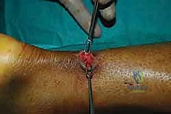 وضع الضمادات والجبيرة